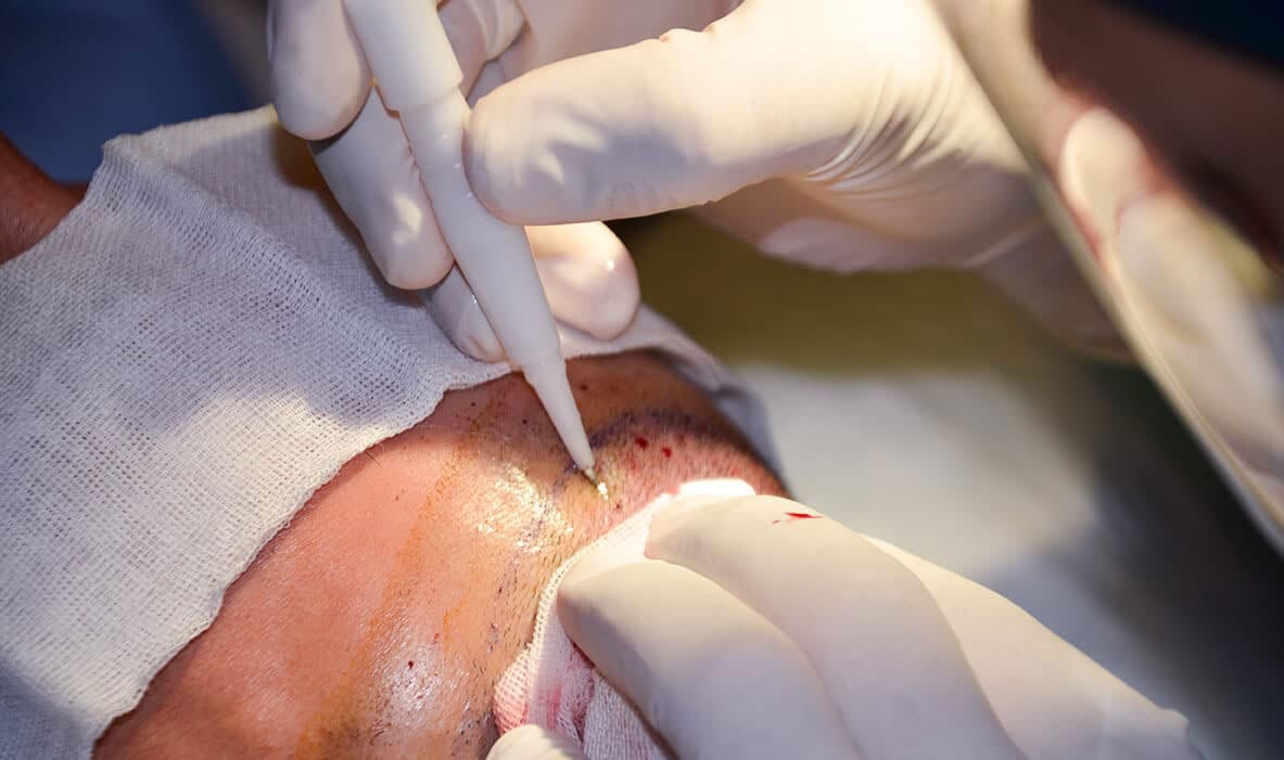 DHI versus FUE hair transplant method comparison