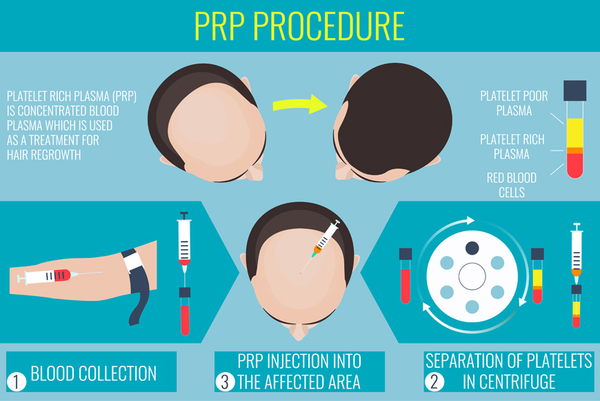 steps in prp treatment
