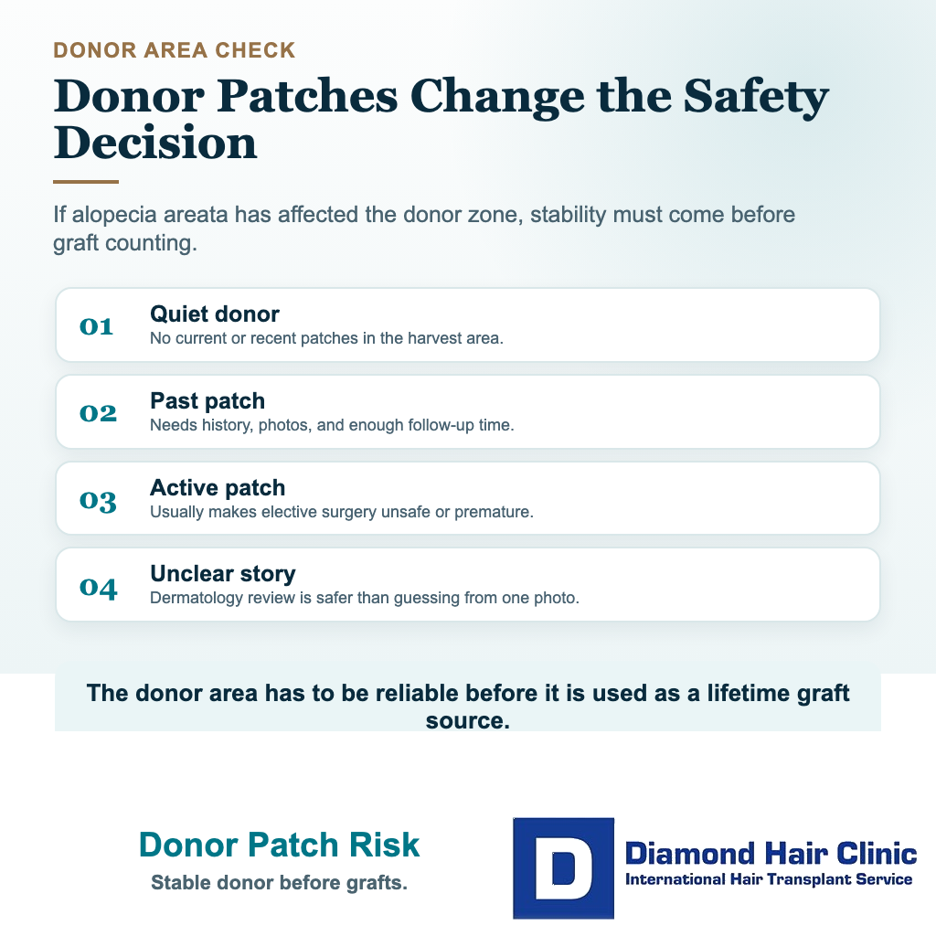 Visual explaining how donor area patch history changes hair transplant planning with alopecia areata