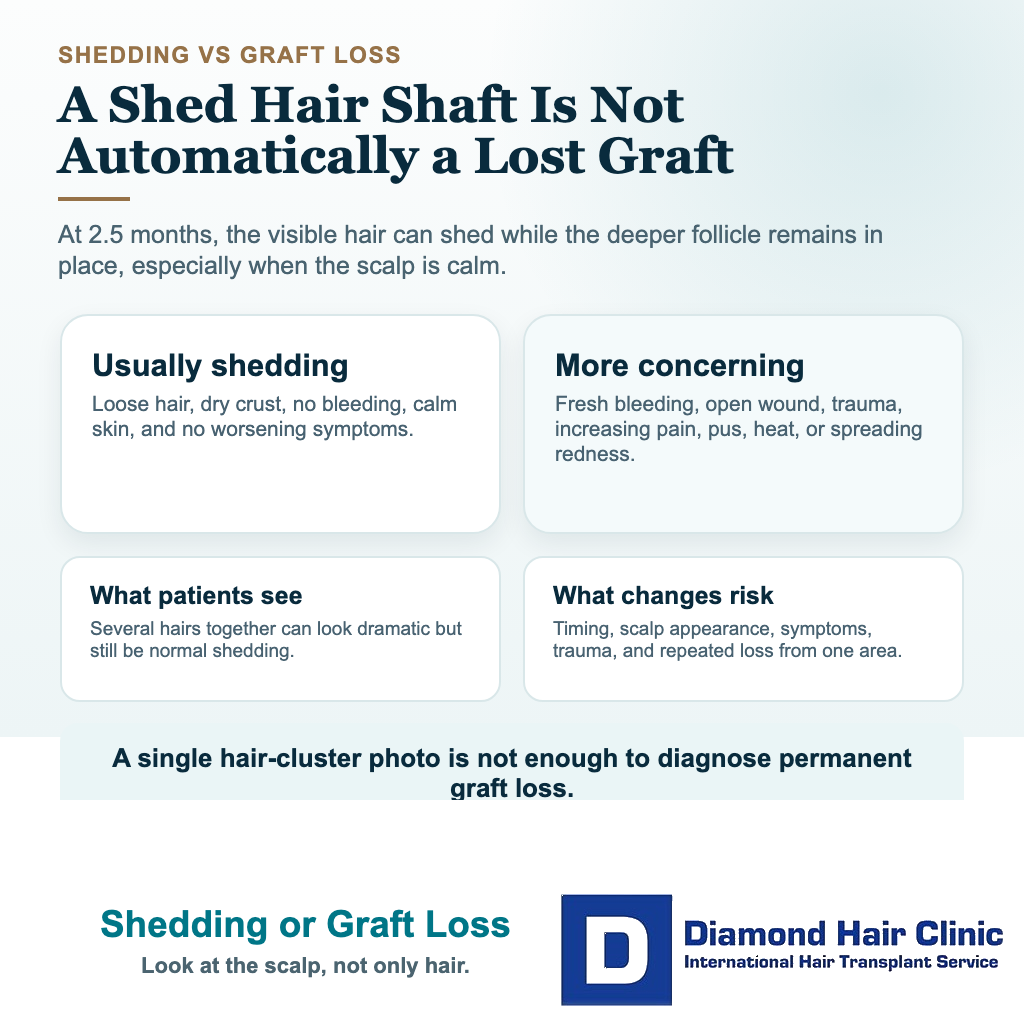 Is Shedding 2.5 Months After Hair Transplant Permanent Graft Loss? visual explaining shedding or graft loss