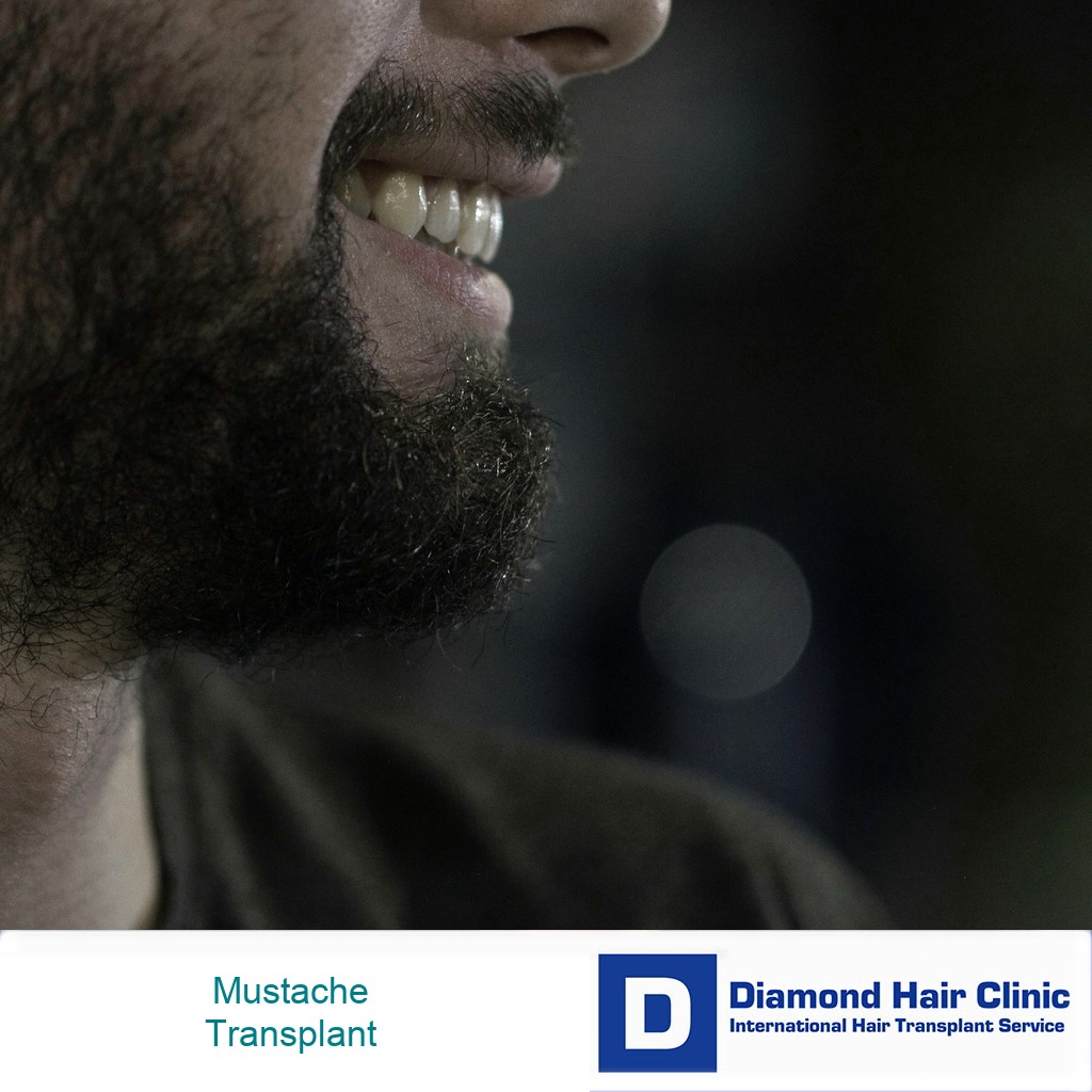 Close facial hair image for mustache hair transplant planning and natural direction
