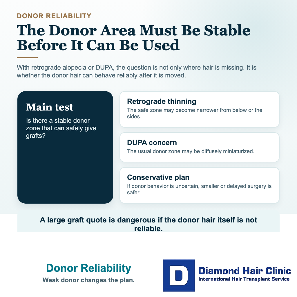 Can I Have a Hair Transplant With Retrograde Alopecia or DUPA? visual explaining donor reliability and safe donor limits