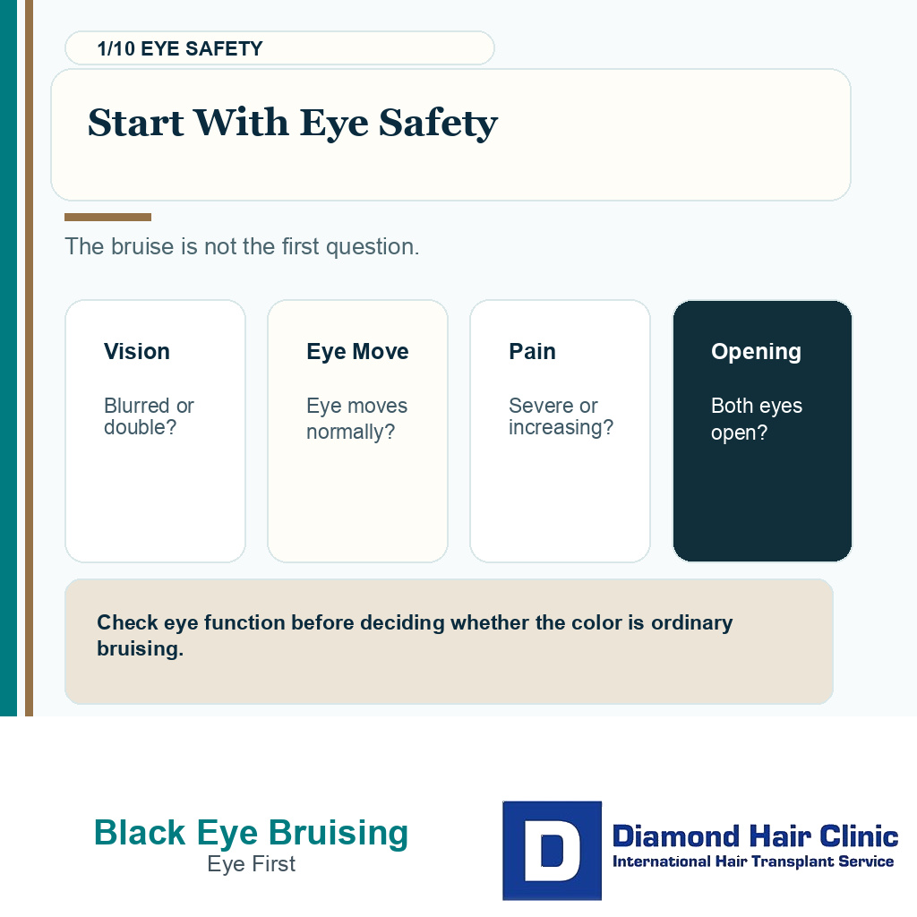 Black eye bruising carousel slide 1 explaining eye safety first