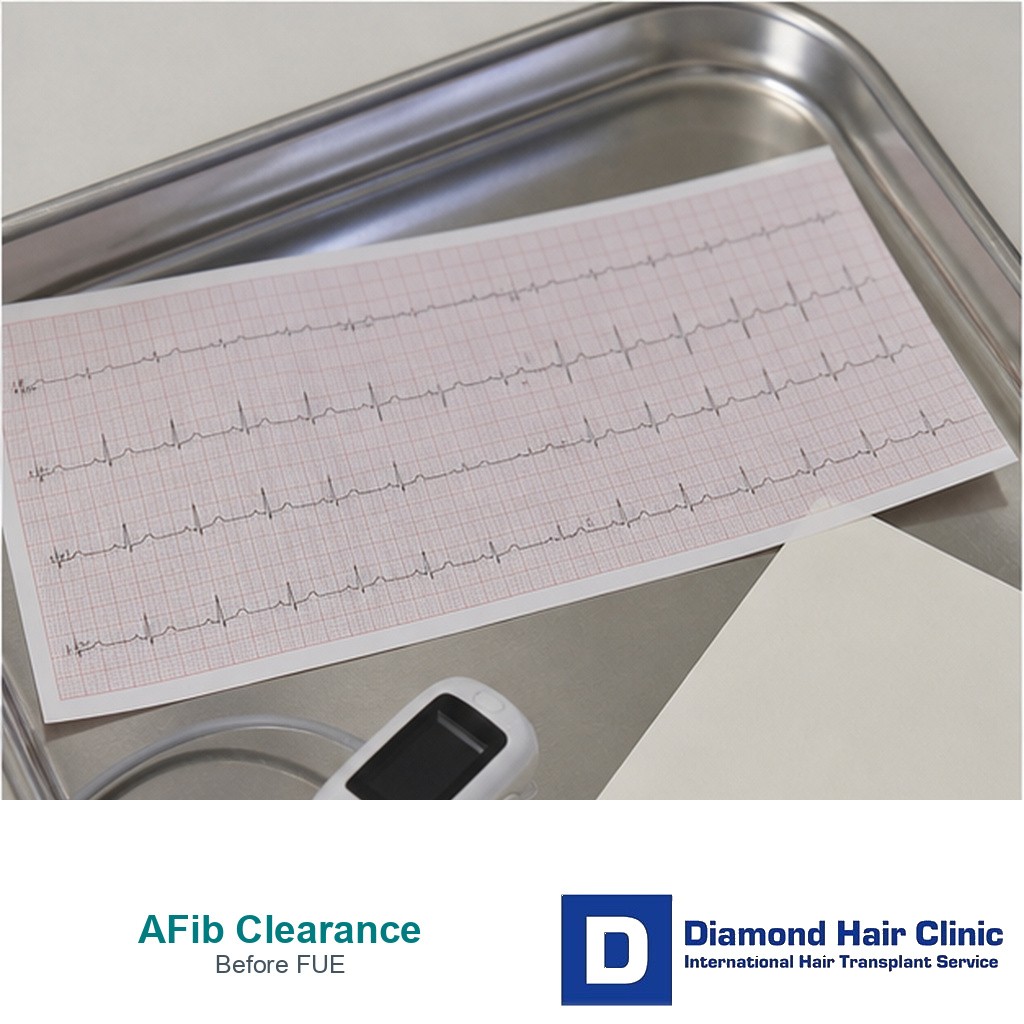Preoperative rhythm and medicine review scene for atrial fibrillation before FUE hair transplant