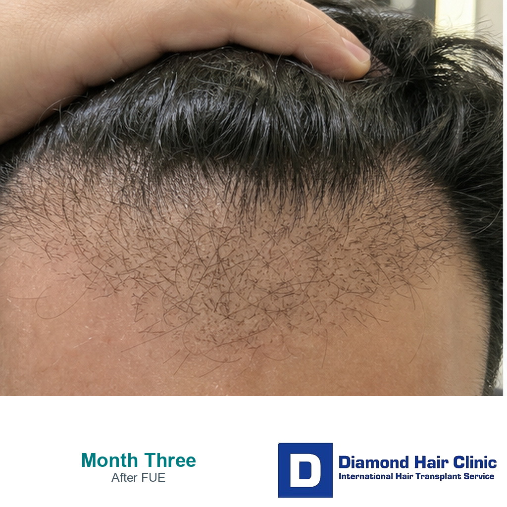Sparse early hairline growth three months after FUE hair transplant