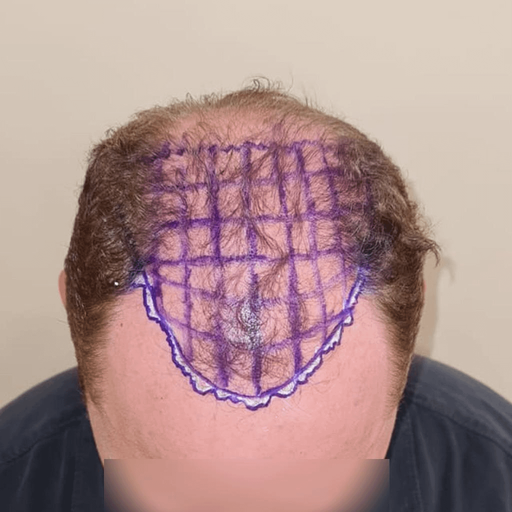 Hairline design with irregular purple markings, shared by Dr. Mehmet Demircioglu on Reddit