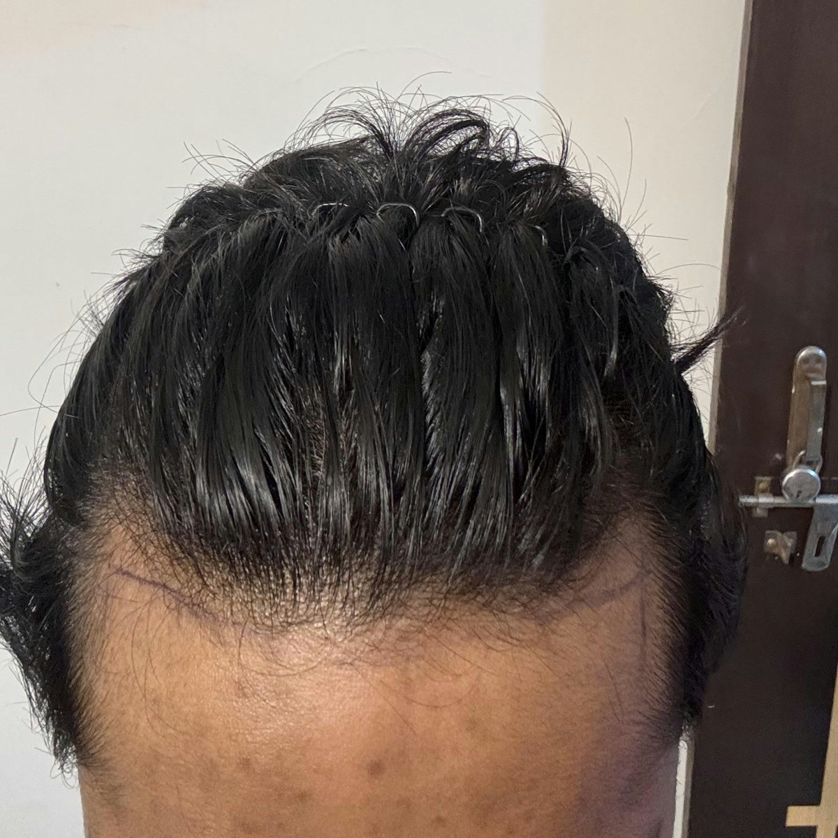 Hairline planning discussion photo 1, cropped above the eyes
