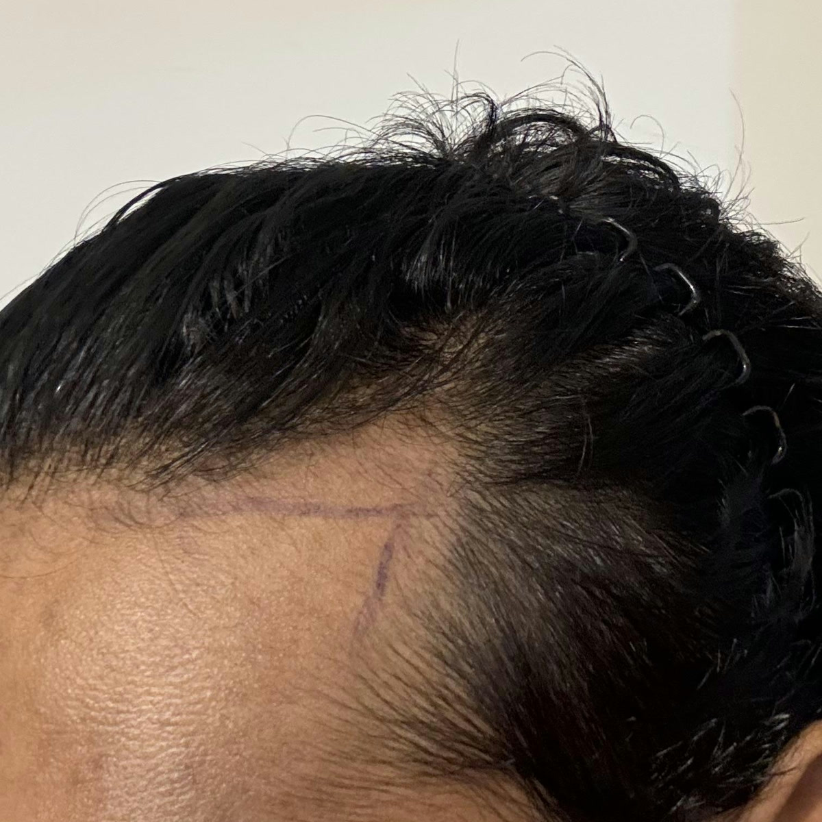 Hairline planning discussion photo 2, cropped above the eyes