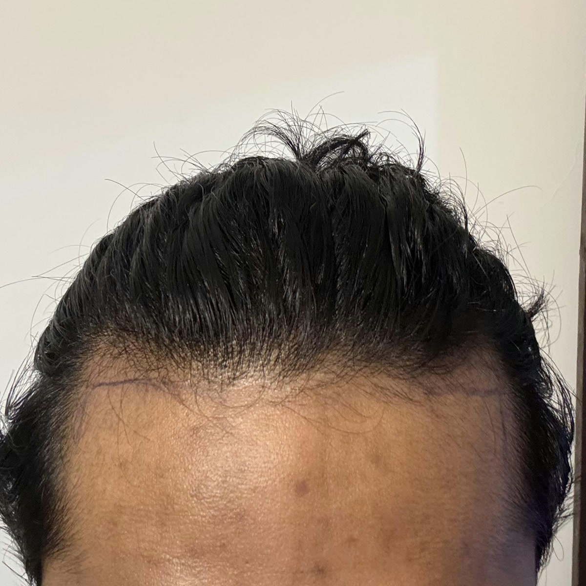 Hairline planning discussion photo 3, cropped above the eyes