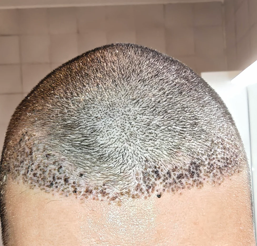 Front view of the hairline one week after the 1300 graft transplant discussed on Reddit