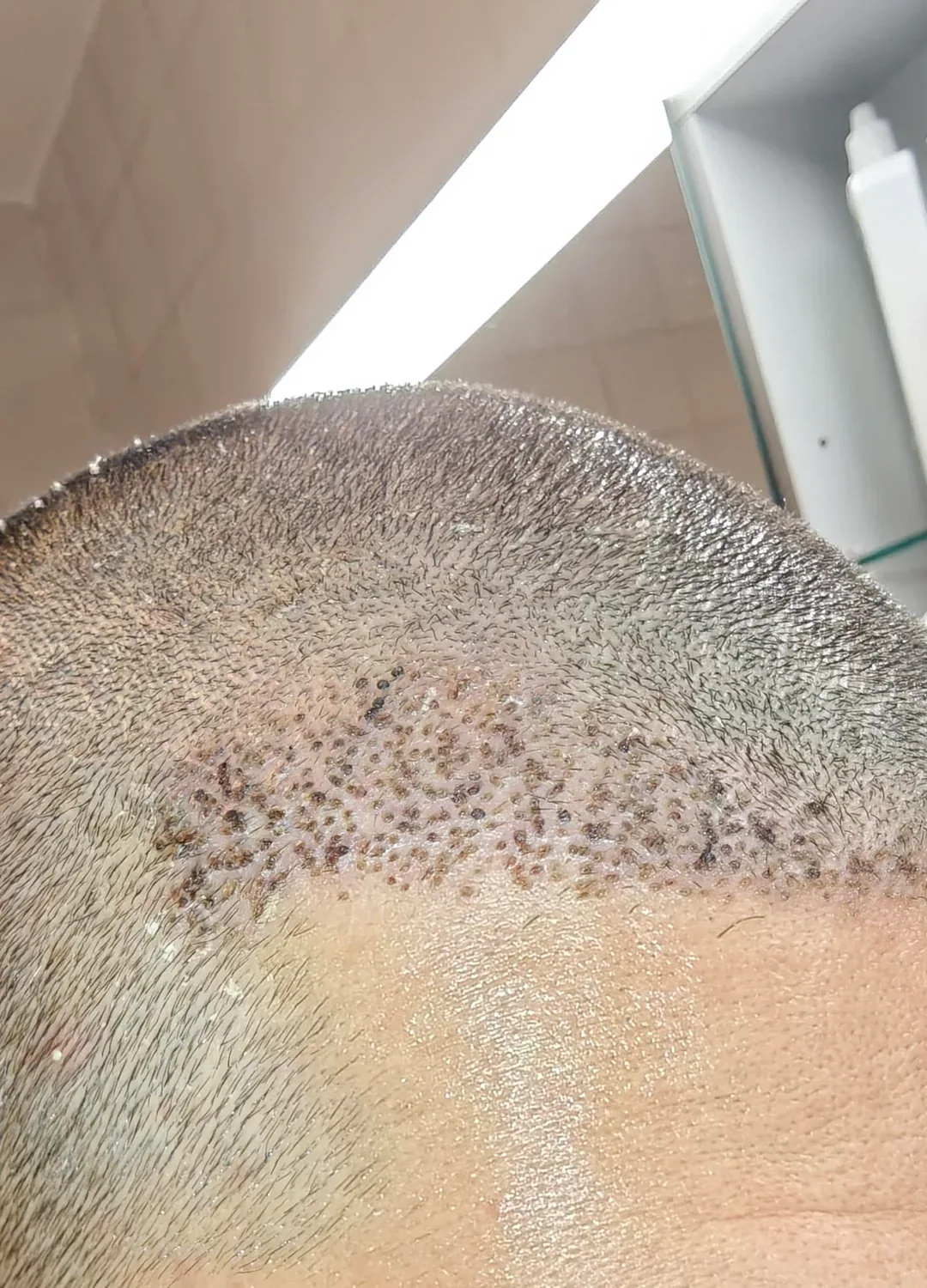 Cropped oblique view of the transplanted hairline with the eyes outside the frame