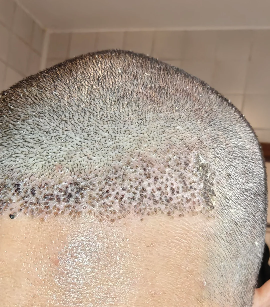 Opposite oblique view of the hairline one week after the transplant discussed on Reddit