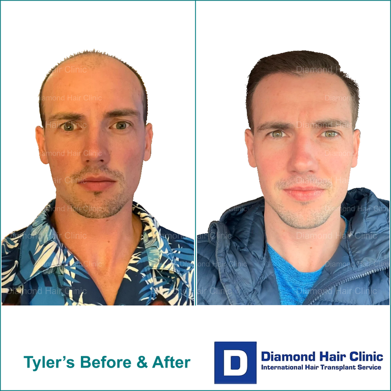 Tyler J. McInnes before and after, with full neck and chest visible, white backgrounds and Diamond Hair Clinic branding