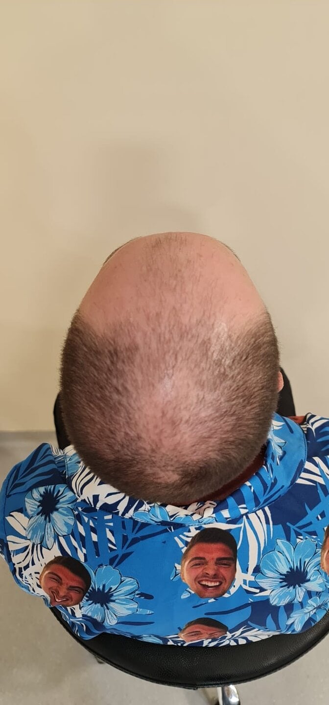 Tyler J. McInnes, before surgery · top view