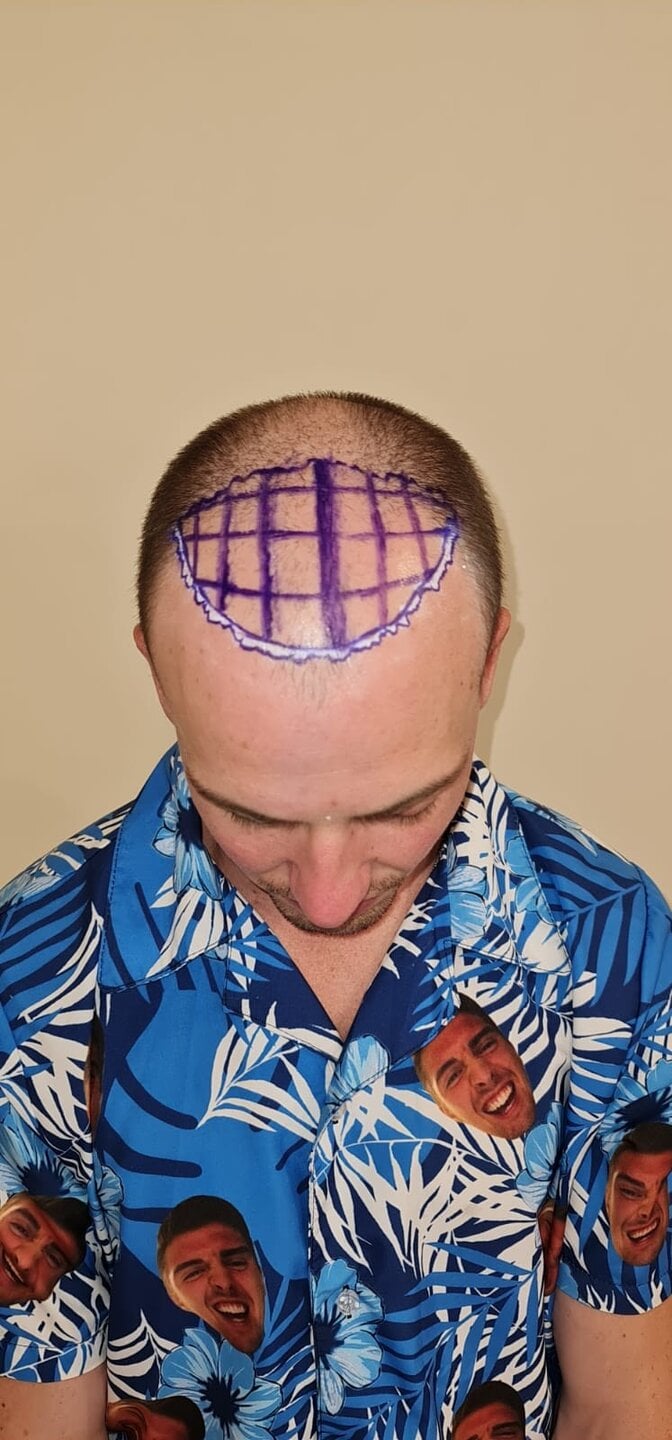 Tyler J. McInnes, hairline design before surgery