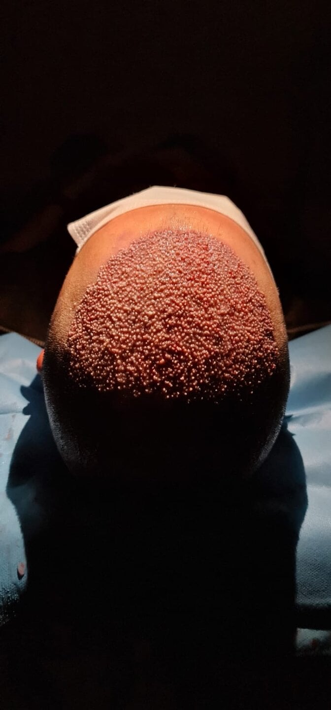 Tyler J. McInnes, after graft placement
