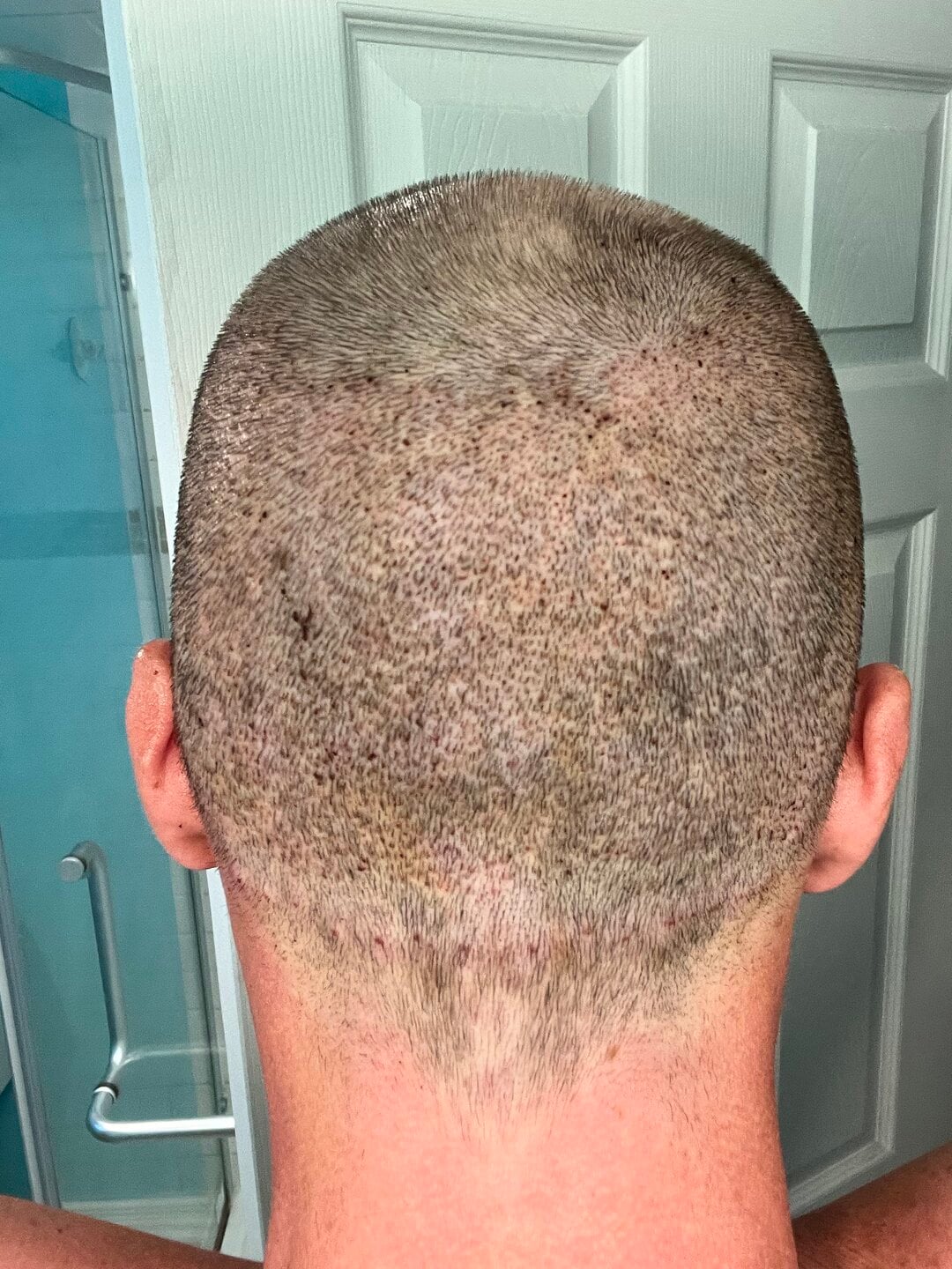 Tyler J. McInnes, recovery · donor area
