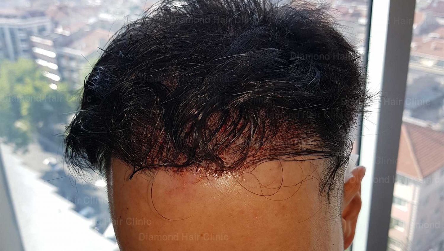 Non-Shaven Hair Transplant - Diamond Hair Clinic - Hair Transplant in Turkey - Dr. Mehmet Demircioglu